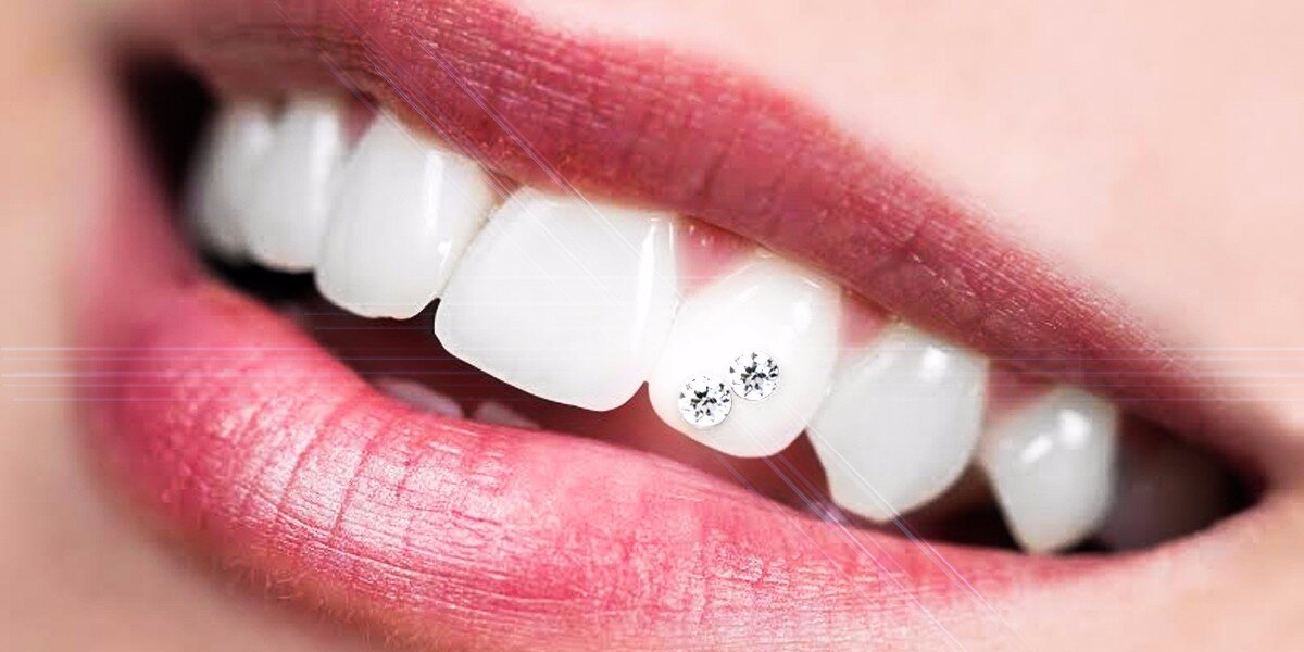 Zubná ozdoba - Skrášľovanie zubov pomocou zirkónového šperku. Bezbolestná aplikácia bez vŕtania.