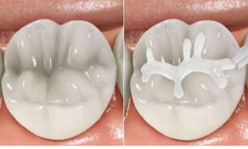 Pečatenie - Pečatenie prvých stálych zadných zubov tzv. 6-tiek u 5-6 ročných detí. Metóda je bezbolestná a bez vŕtania. Slúži ako prevencia zubného kazu u detí.